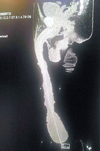 An X-ray of Roberto's member. Roberto Esquivel Cabrera, 52, boasts an appendage measuring 18.9 inches long. 