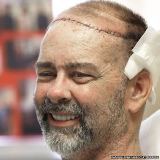 A 55-year-old American man has become the first recipient of a skull and scalp transplant ? and an unintentional hair transplant at the same time. James Boysen, a software engineer from Austin, Texas, had the 15-hour procedure performed to repair an open wound on the top of his head from radiation therapy for cancer.