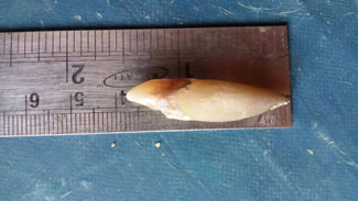  Dentist Jaimin Patel conducted a surgical procedure to remove a cannie teeth from a young college student; the human tooth that he had extracted was 3.7 cm - 5 mm longer - than the current world record of 3.2 cm.