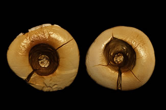  Researchers have discovered ancient dental fillings in northern Italy, the world's oldest. The fillings were found inside a pair of 13,000-year-old front teeth. They were made of bitumen, a semi-solid form of petroleum. Bitumen might have been used as an antiseptic. 