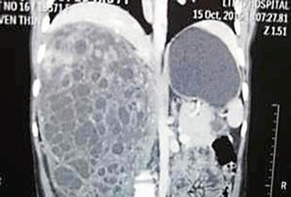 Doctors from the civic-run Sion Hospital have set a new world record by removing the heaviest kidney tumour documented in medical literature weighing 5.5kg. 