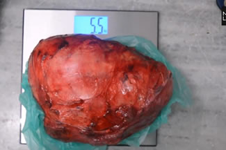 Doctors from the civic-run Sion Hospital have set a new world record by removing the heaviest kidney tumour documented in medical literature weighing 5.5kg. 