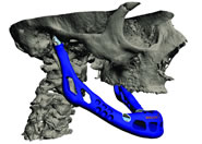 first 3D printed jaw transplant LayerWise